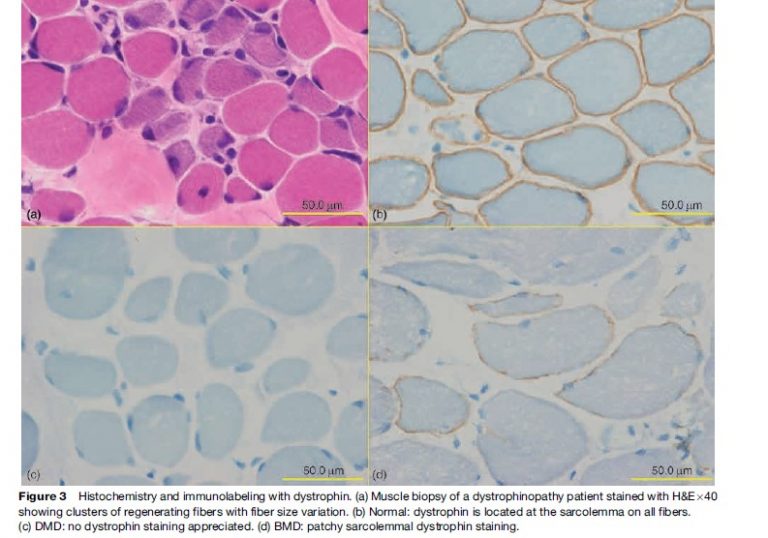 muscle dystrophy research paper