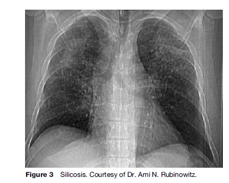 Occupational Lung Diseases Research Paper