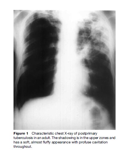Tuberculosis Diagnosis Research Paper