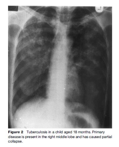Tuberculosis Diagnosis Research Paper